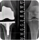 Artroplastia de rodilla