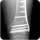 Osteotomía Desrotadora Femoral y/o Tibial