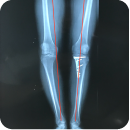 Osteotomía de realineación de la rodilla