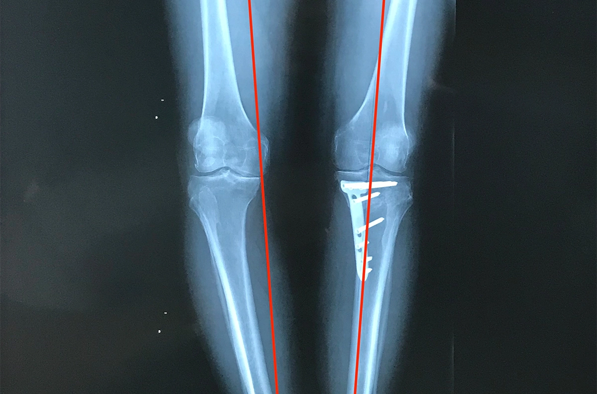 Radiografía de una osteotomía de alineación de rodilla