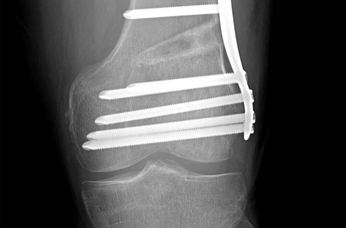 Radiografía de una osteotomía desrrotadora femoral